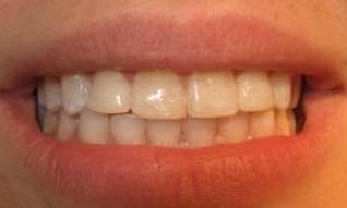 Composite-esthetic-build-up-of-upper-left-and-upper-right-lateral-incisors-After-Image