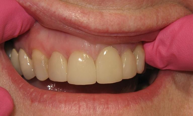 Crowns-upper-right-lateral-incisor-to-left-lateral-incisor-After-Image