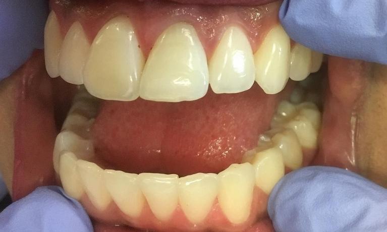 Upper-left-central-incisor-has-darken-over-time-from-root-canal-treatment-After-Image