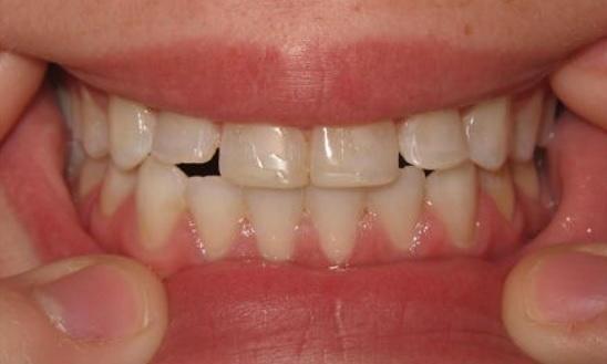 Composite-esthetic-build-up-of-upper-left-and-upper-right-lateral-incisors-Before-Image