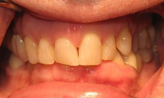 Crowns-upper-right-lateral-incisor-to-left-lateral-incisor-Before-Image