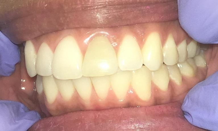 Upper-left-central-incisor-has-darken-over-time-from-root-canal-treatment-Before-Image